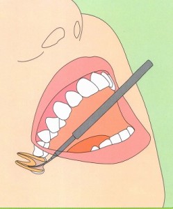 歯の神経治療（根管治療） 歯の神経を取る治療
