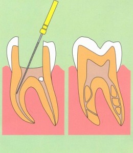 歯の神経を取る治療（根管治療）をしたのに歯が痛いのはなぜ？
