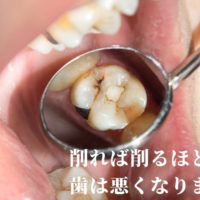 削らない虫歯治療なら高松市の吉本歯科医院