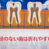 神経を取った歯は折れやすく寿命が短くなります｜香川県高松市の歯の神経治療　吉本歯科医院