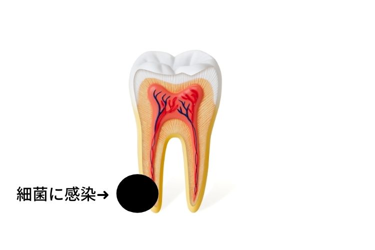 神経がない歯が痛い原因｜高松市の吉本歯科医院