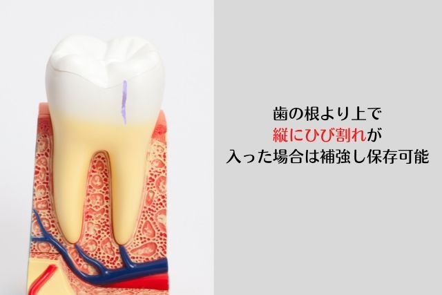 歯の根に縦にひび割れが入った場合は抜歯｜高松市の吉本歯科医院