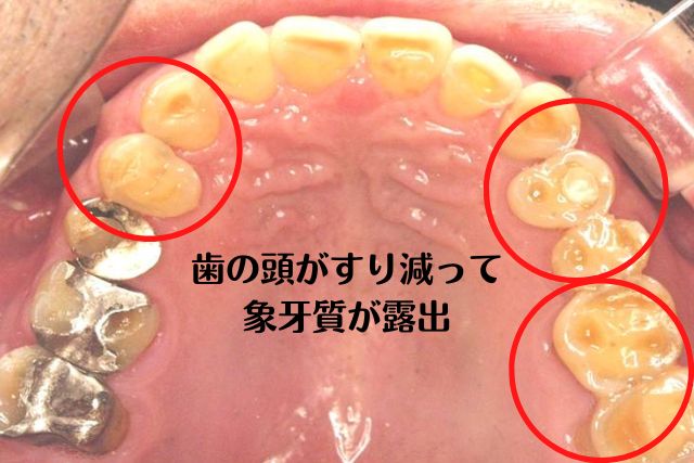 冷たいものを飲むと歯の神経が痛い｜香川県高松市の歯の神経治療なら吉本歯科医院